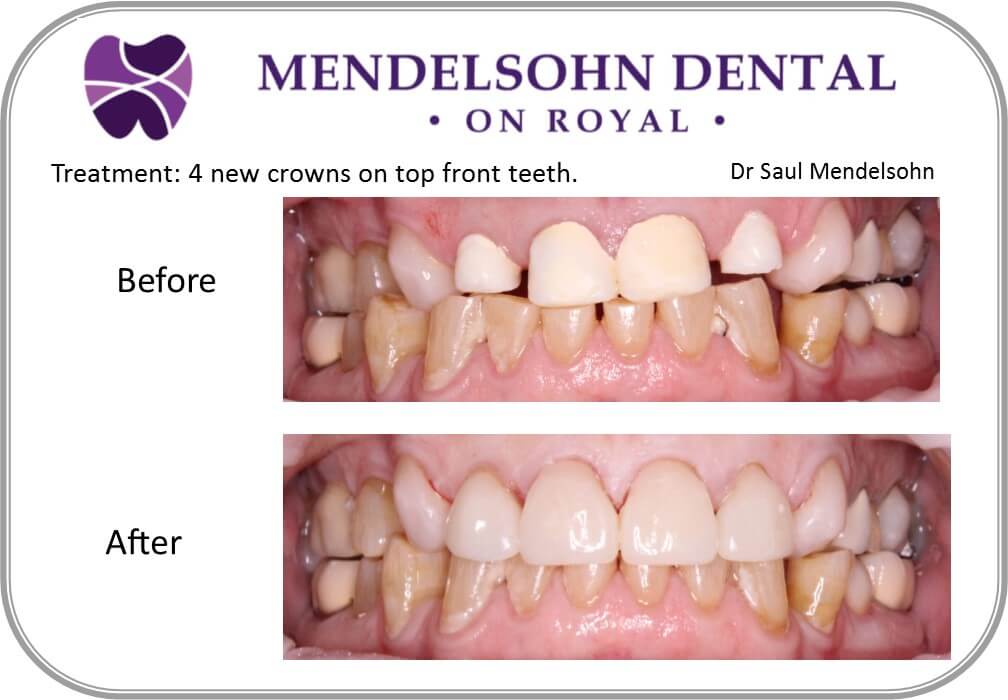 Crowns - mendelsohn dental