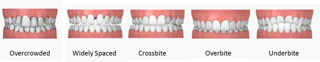 Overbite