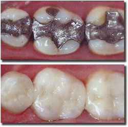 CEREC Restorations