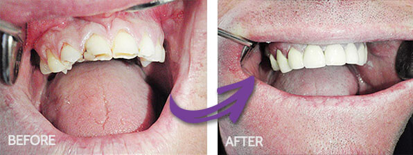 Fix crown - mendelsohn dental