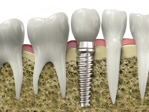 Tooth implant - mendelsohn dental