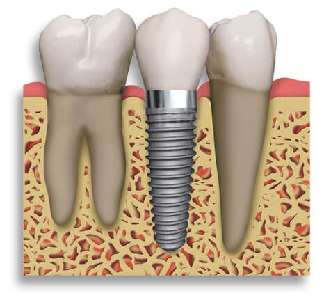 implant