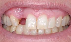missing tooth - mendelsohn dental