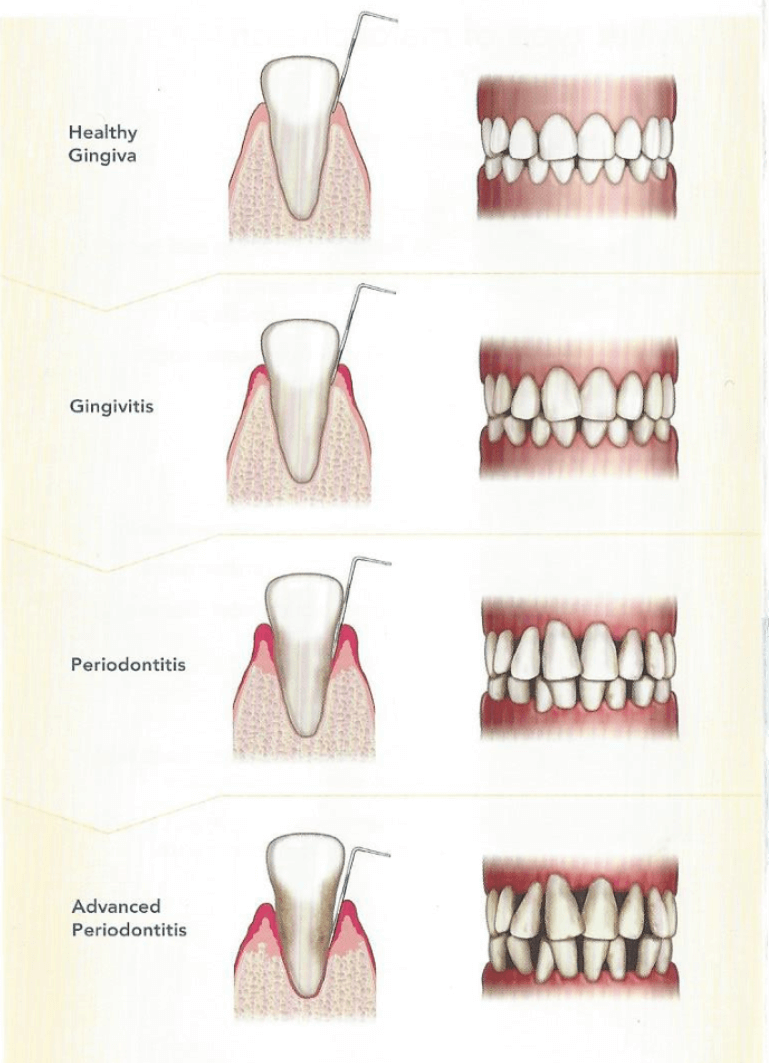 perio disease - mendelsohn dental