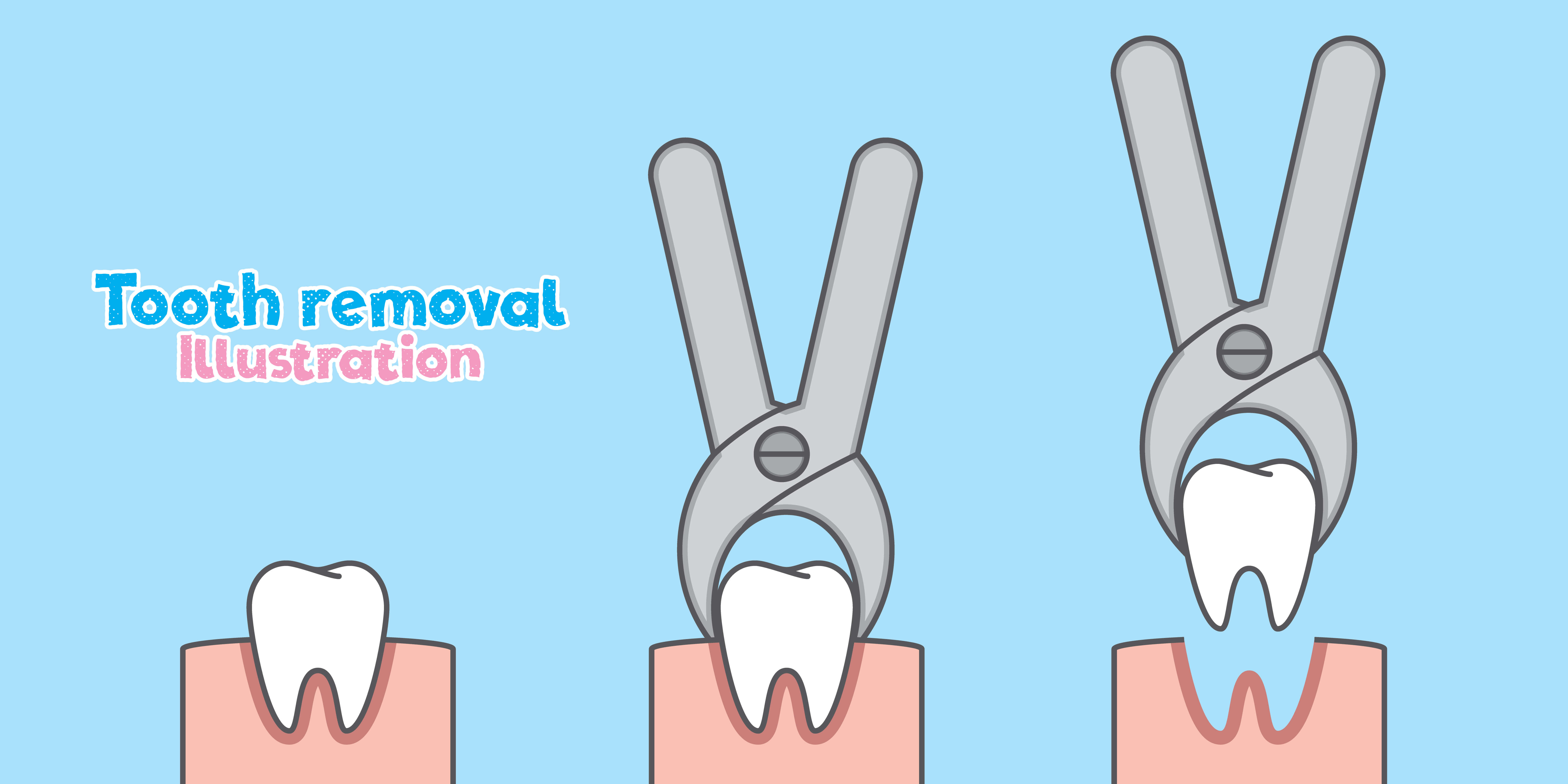 tooth removal - mendelsohn dental