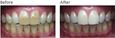 Treatment 2 - mendelsohn dental