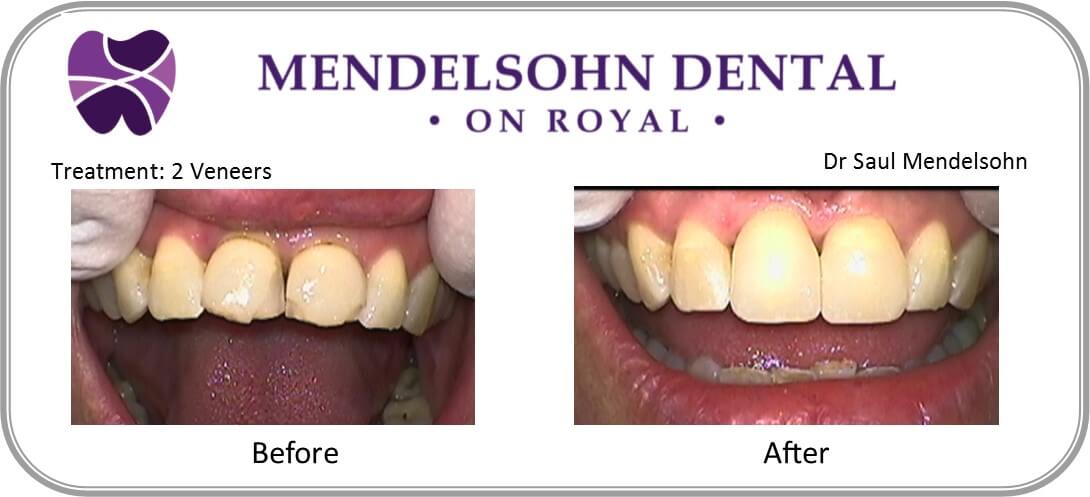 Crowns 3 - mendelsohn dental