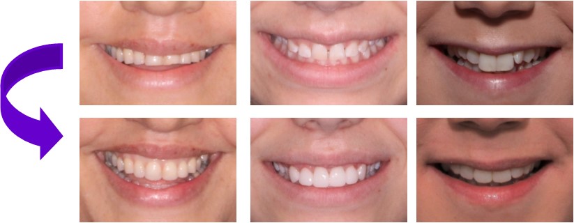 veneers teeth - mendelsohn dental