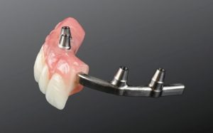 dent-imp-img-12 | Mendelsohn Dental on Royal