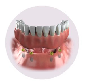 dent-imp-img-14 | Mendelsohn Dental on Royal