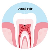 Root Canal