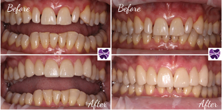 porcelain Veneers | Mendelsohn Dental on Royal