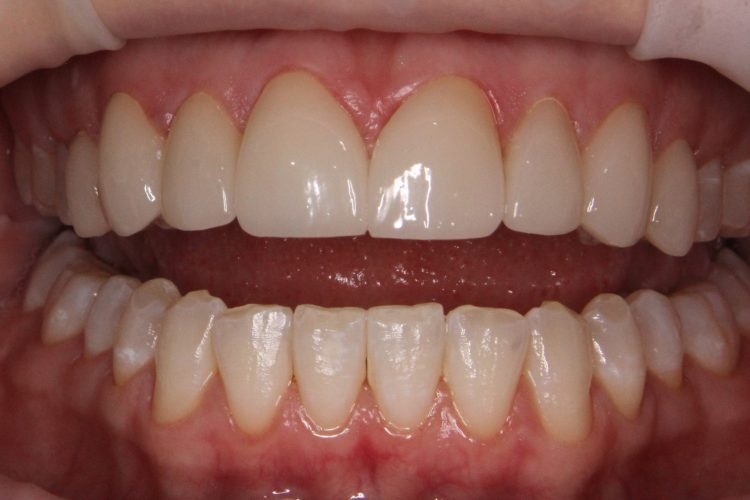 porcelain veneers | Mendelsohn Dental on Royal