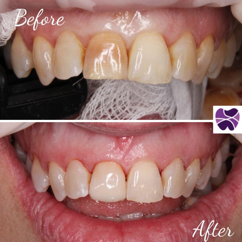 porcelain veneers | Mendelsohn Dental on Royal