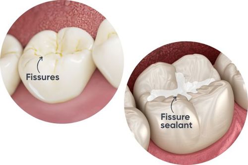 fissure-and-fissure-sealant | Mendelsohn Dental on Royal