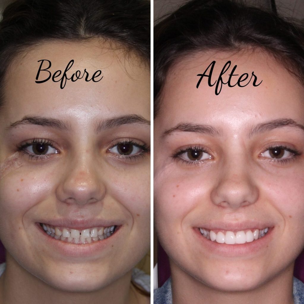 veneers | Mendelsohn Dental on Royal