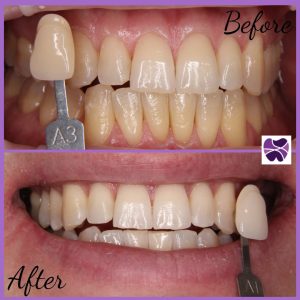 Whitening | Mendelsohn Dental on Royal