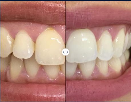 Teeth Whitening | Mendelsohn Dental on Royal