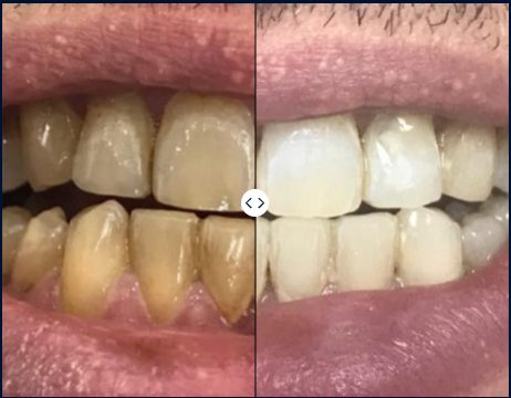 Teeth Whitening | Mendelsohn Dental on Royal