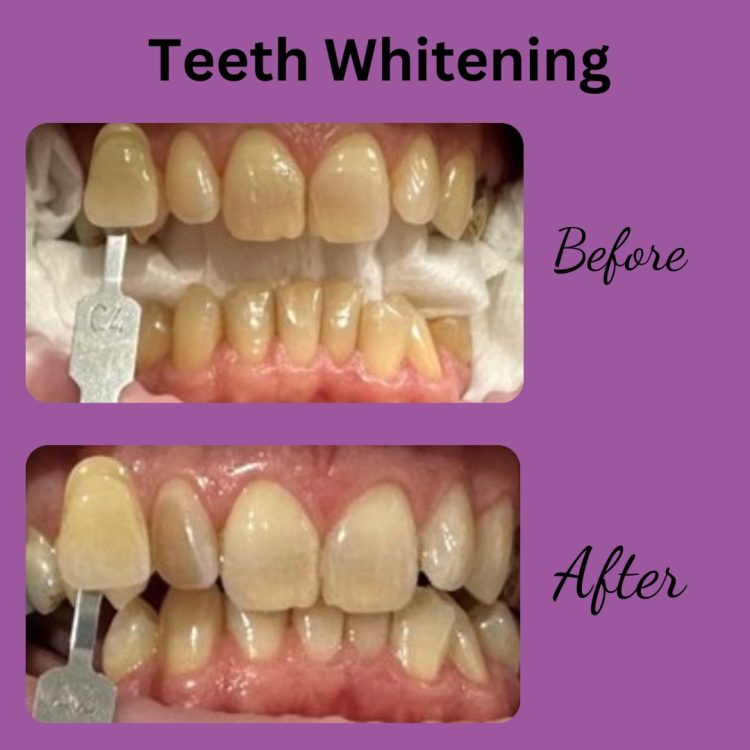 Teeth whitening | Mendelsohn Dental on Royal Whiter brighter teeth